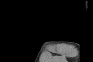 Schwarze und weiße MRI-Aufnahme eines Knies, die detaillierte Innenansicht zeigt.