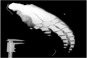Ein Röntgenbild eines Männerbeins mit einem Bruch in der Mitte, mit einem Metallband auf der linken Seite, vor einem schwarzen Hintergrund.