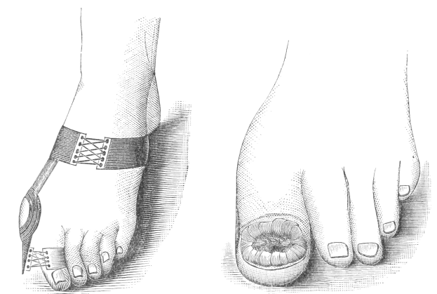 Schwarze und weiße Zeichnung eines Paares Füße, einer mit einem Verband und der andere mit einer Fraktur, mit Text, der die Behandlung angibt.